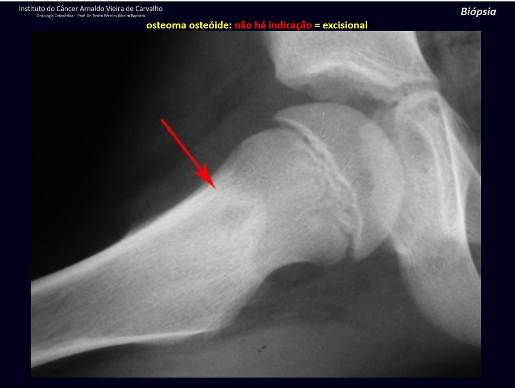 Figura 20: Radiografia de osteoma osteóide no colo femoral. Lesão lítica, com nicho central e halo de esclerose, seta vermelha.