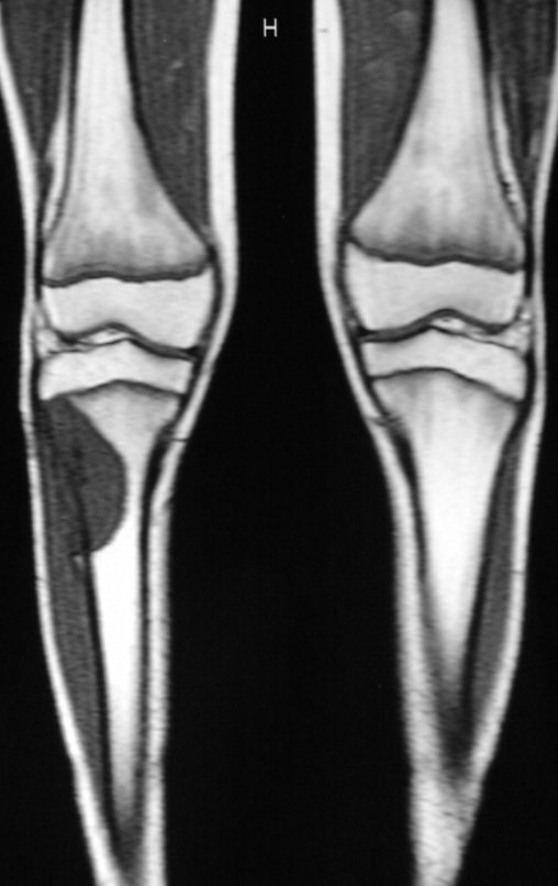 Figura 9: RM em T1, de 02/10/1999, pós quimioterapia, com lesão de baixo sinal, na região lateral da metáfise proximal da tíbia direita e diminuição do volume tumoral extracortical.