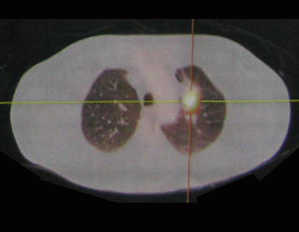 Figura 20: Corte axial de Pet-Ct com lesão no pulmão esquerdo, SUV=13,2.