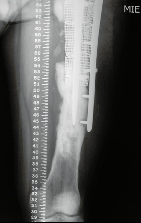 Figura 18: Radiografia com detalhe da soltura no segmento distal, pré-operatório de revisão em um tempo.