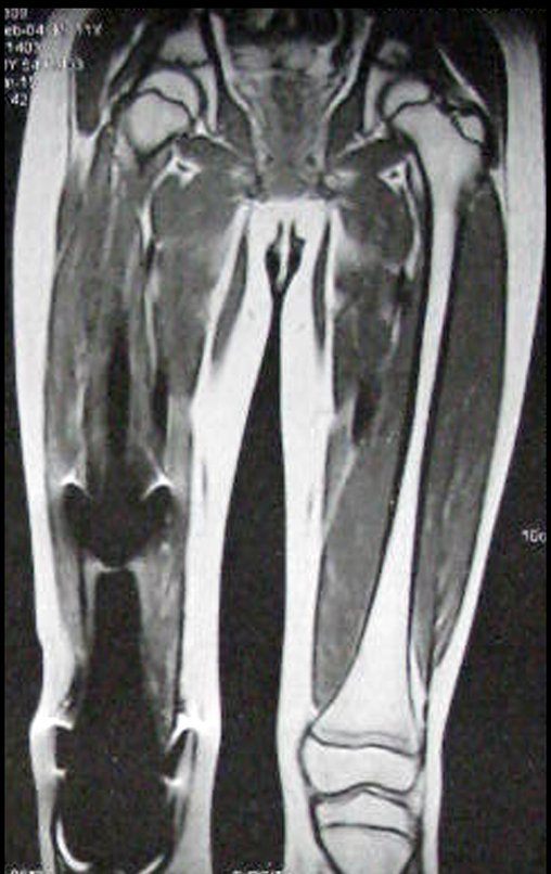 Figura 123: Ressonância coronal T1, de onze meses após a cirurgia, documentando a endoprótese.