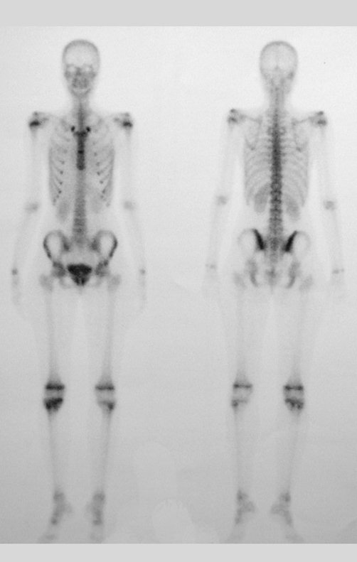 Figura 13. A: Fase tardia mostrando lesão única no esqueleto.