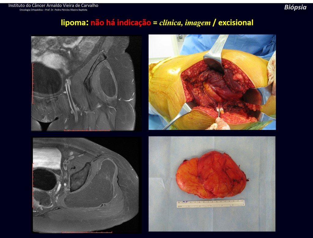 Figura 74: Ressonância confirmando ser tecido gorduroso homogêneo, captação de contraste apenas na periferia do tumor. Ressecção da lesão envolta em sua pseudocápsula. LIPOMA.