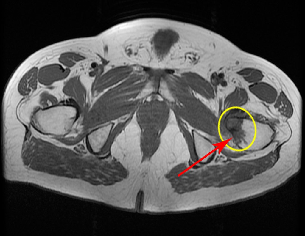 Figura 50: RM axial, lesão lítica no pequeno trocânter e erosão da cortical, com aumento do edema na medular, seta em vermelho.