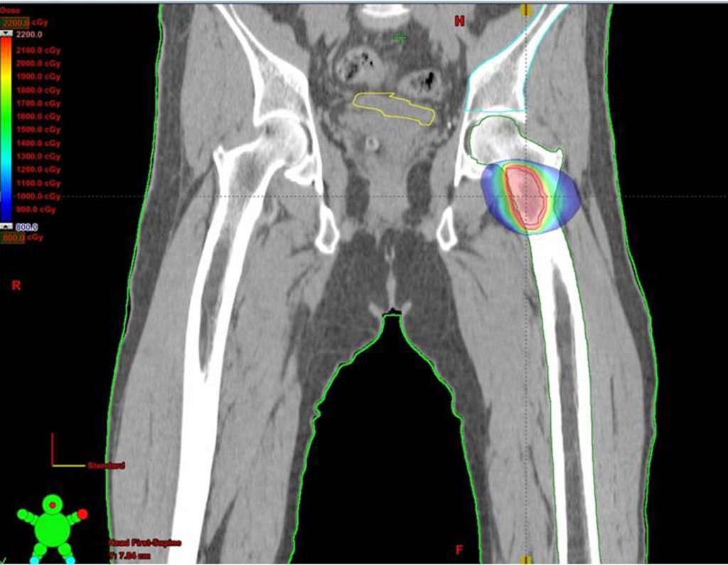 Figura 26c: Imagem de TC em corte coronal com distribuição de dose no Fêmur esquerdo.