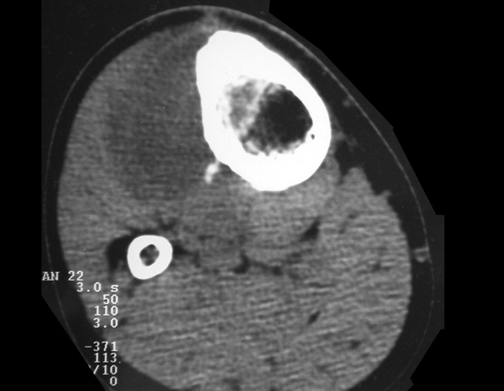 Figura 5: Tomografia de 29/04/1999, lesão condensante na medular do 1/3 proximal da tíbia, com lesão extracortical na região ântero-lateral, densidade para osso.
