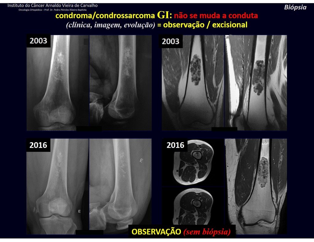 Figura 43: Lesão cartilaginosa latente, acompanhada desde 2003, sem a realização de biópsia, comportamento de condroma. Imagem em 2016 sem alteração. Conduta = manter o acompanhamento, se houver alteração deve ser tratada como condrossarcoma.