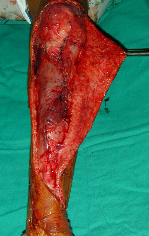 Figura 48: Fechamento do plano muscular e revisão da hemostasia.