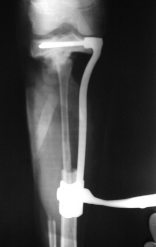 Figura 57: Radiografia de controle intraoperatório, frente.