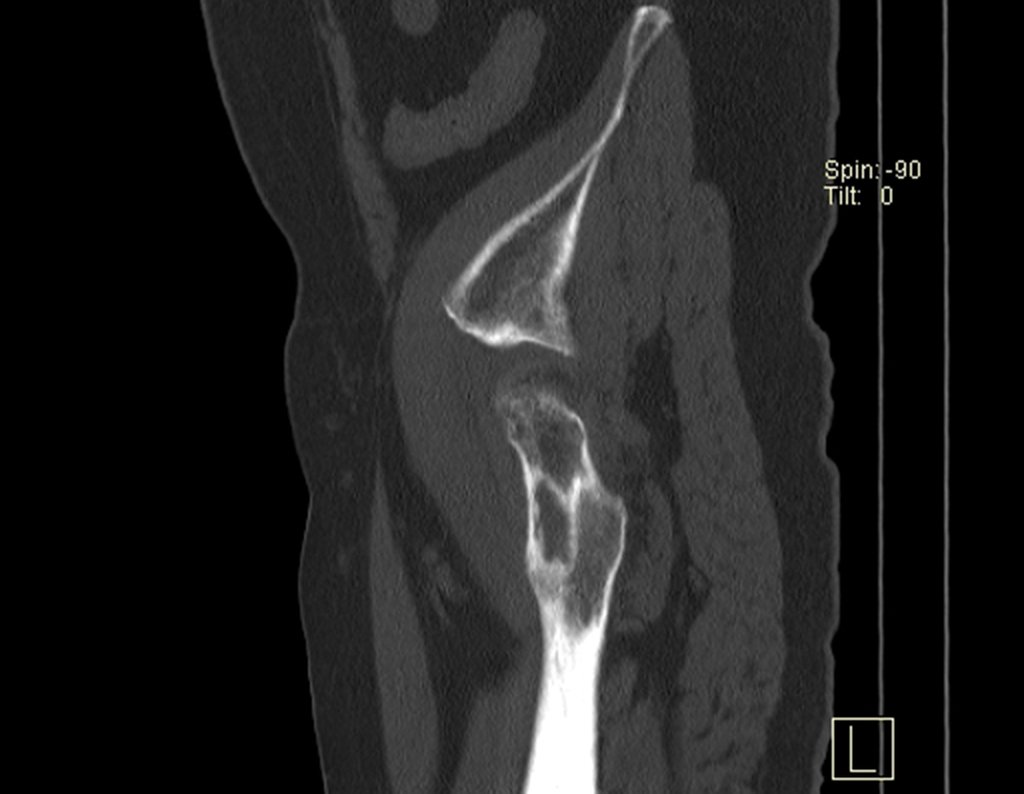 Figura 69: Tomografia do fêmur em corte sagital, com duas áreas de rarefação, ocupando mais de 50% da largura do colo.