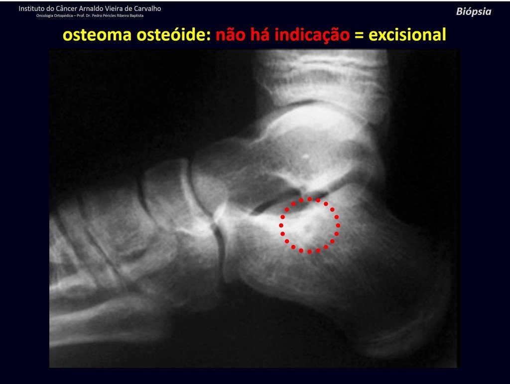 Figura 25: Osteoma osteóide do calcâneo. Não há indicação de biópsia.