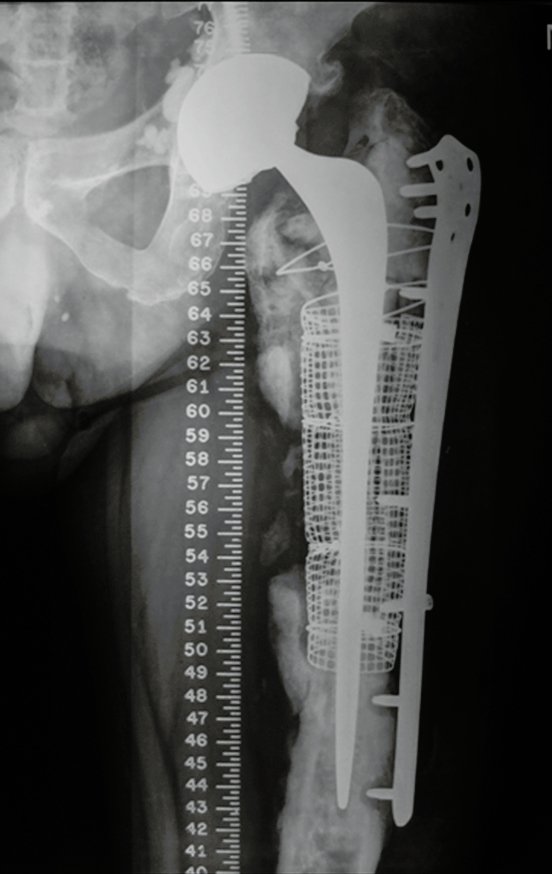 Figura 17: Radiografia do quadril esquerdo frente, com régua, evidenciando a má qualidade do osso e a soltura da prótese e da osteossíntese.