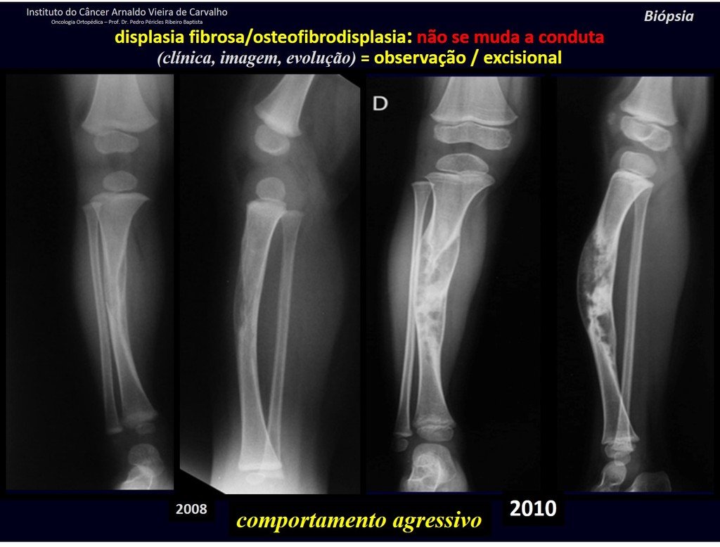 Figura 65: Lesão diafisária em criança com um ano de idade, com aumento acentuado e deformidade progressiva em dezoito meses. OSTEOFIBRODISPLASIA.