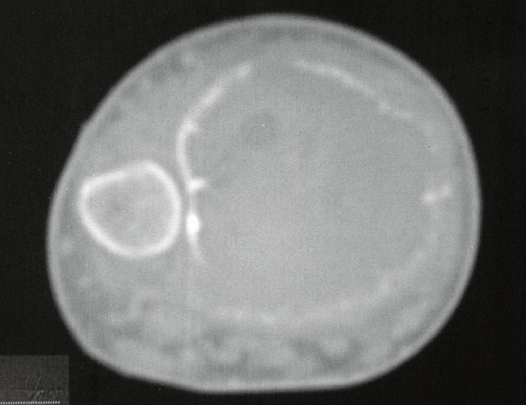 Figura 4: TC, densidade para tecido ósseo, com a cortical insuflada, sem tumor extracortical.