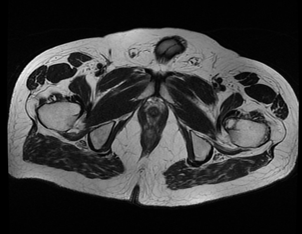 Figura 44: Tomografia axial, lesão e edema no pequeno trocânter.