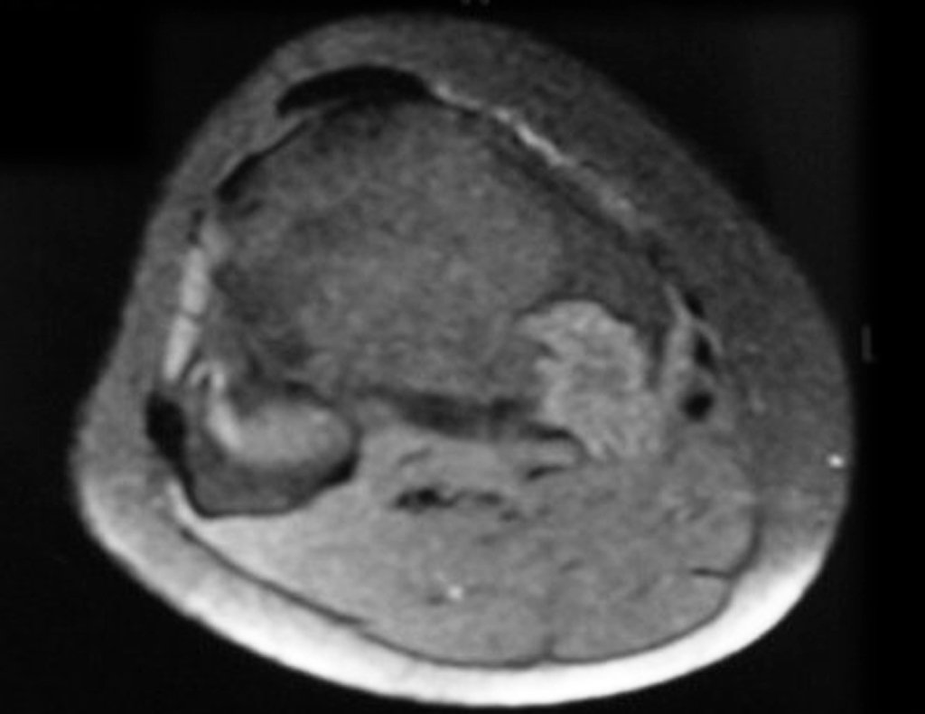 Figura 7: RM ax T1, com supressão de gordura, evidencia erosão da cortical e tumor extraósseo que contorna externamente a cortical.