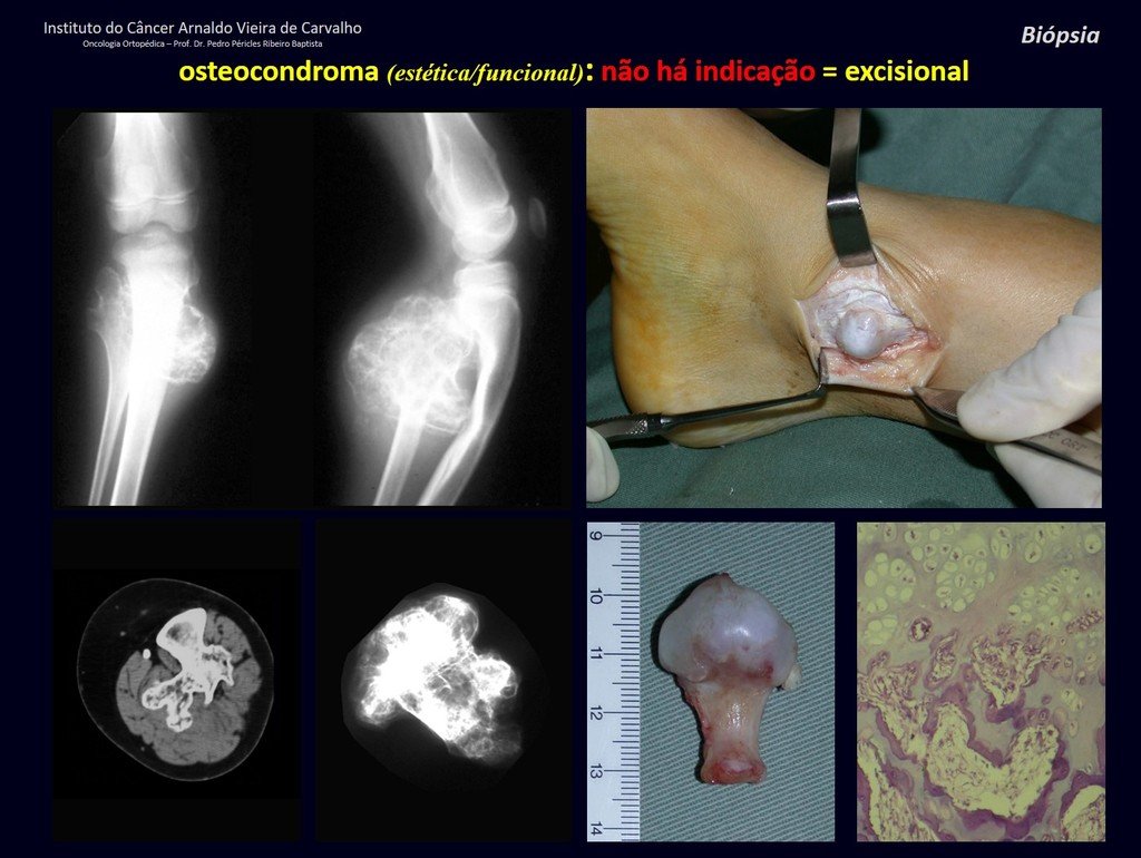 Figura 32: Osteocondroma da fíbula comprimindo lentamente a tíbia, durante o crescimento, e ocasionando deformidade angular em valgo e antecurvatum. Exostose no pé dificultando o uso de calçado. Peças e histologia.