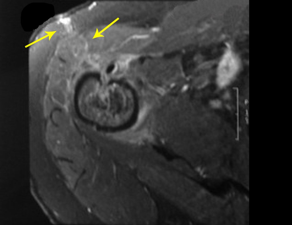 Figura 9: Rm ax T1, com saturação de gordura, evidencia o edema da cicatriz da biópsia e a implantação de tumor nos tecidos moles, no trajeto da biópsia.