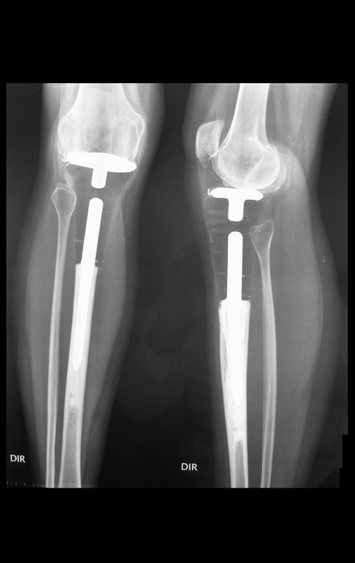 Figura 120: Radiografia de frente e perfil, dois anos e sete meses de pós-operatório.