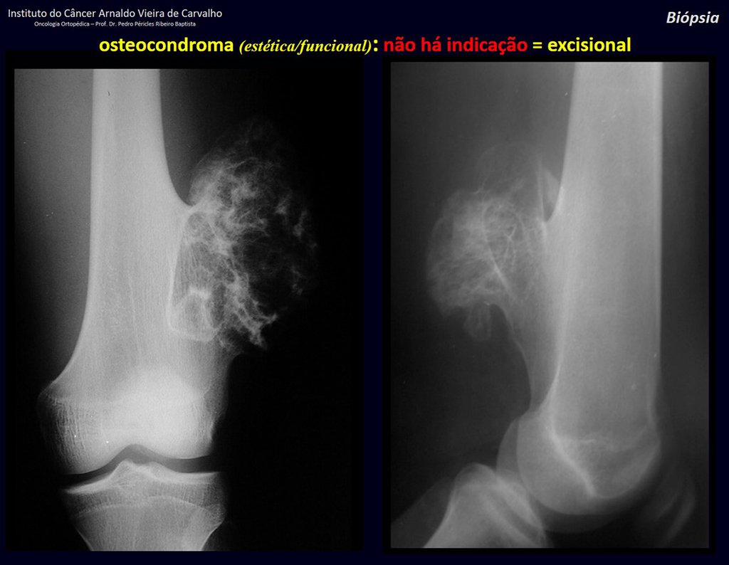 Figura 31: Osteocondroma séssil do fêmur, deslocando os vasos femorais. A cortical do osso continua-se com a cortical da lesão e a medular do osso também se continua com a medular da exostose.