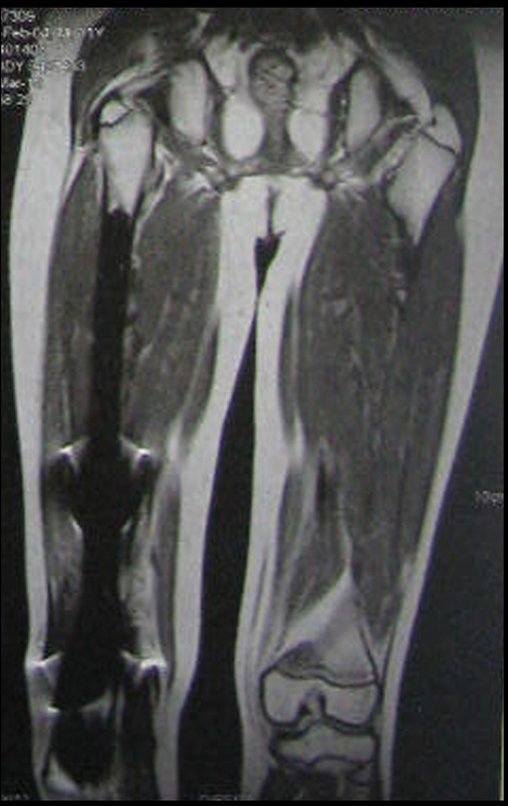 Figura 122: Ressonância de 22/04/2015, onze meses após a cirurgia, em incidência coronal T1 documentando a endoprótese, com imprecisão pelos artefatos da imagem.