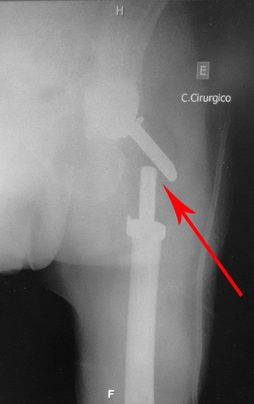 Figura 106: Radiografia do pós-operatório imediato. A seta mostra que a haste do colo não é contínua com a haste femoral. São unidas pelo corpo de polietileno que propicia elasticidade, evitando-se ruptura por stress.