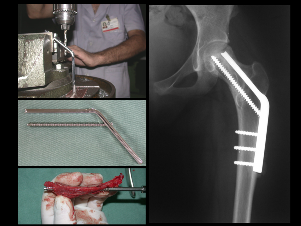 Figura 68: Reconstrução de fratura do colo femoral com enxerto autólogo estrutural de crista ilíaca.