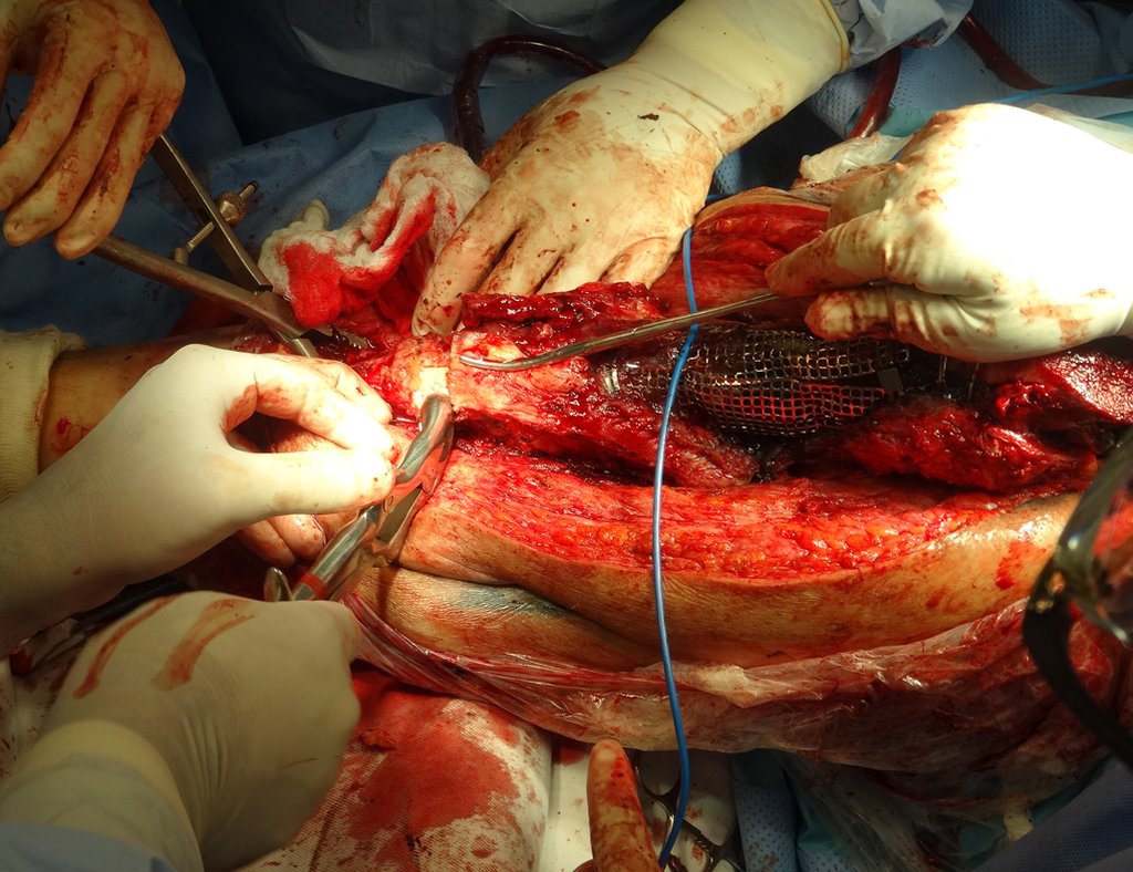 Figura 27: Ressecção de fibrose póstero inferior e preparação do nível de osteotomia femoral.