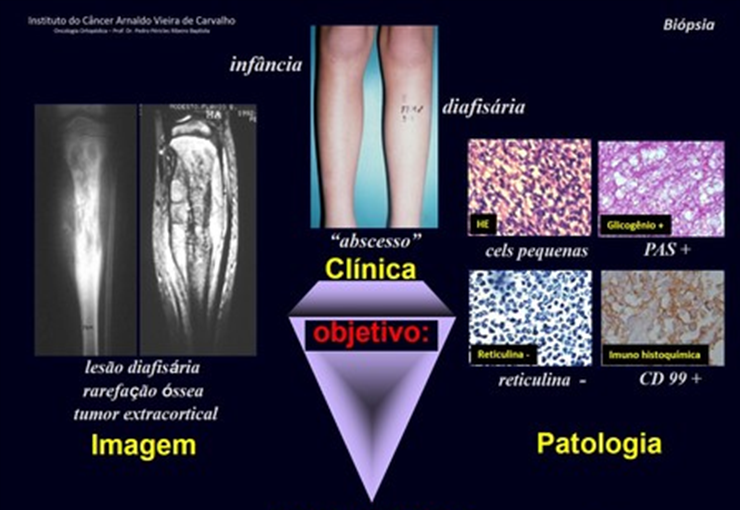 Introdução Ao Estudo Dos Tumores Ósseos