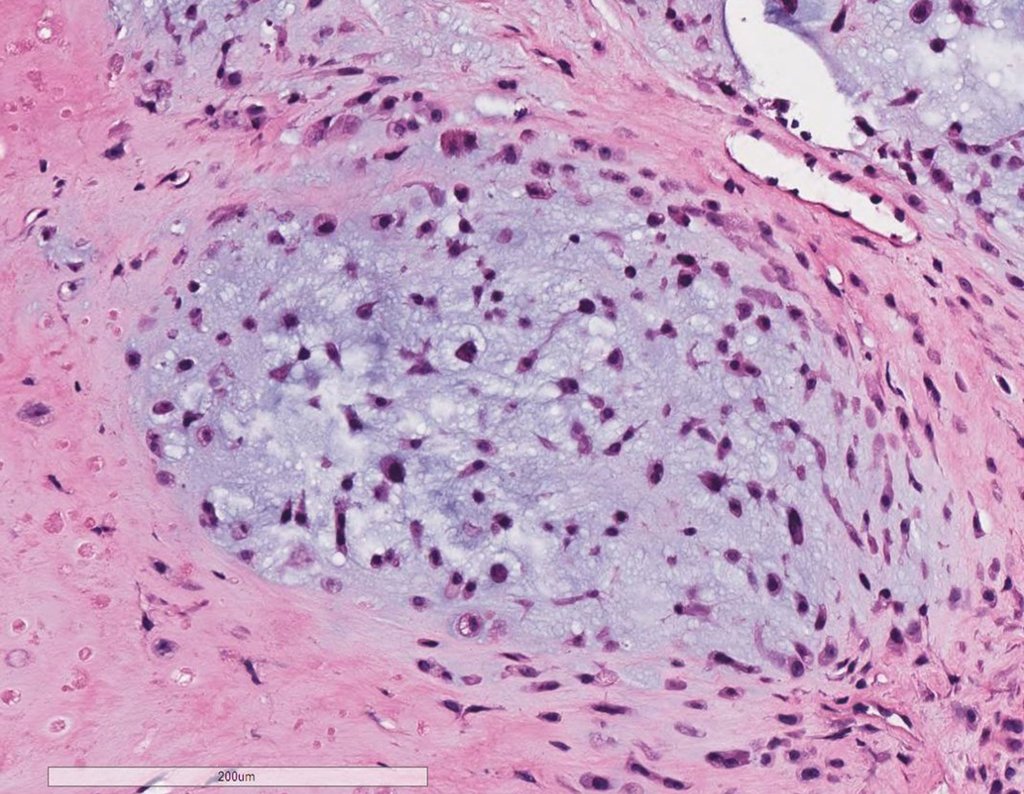 Figura 110: Hematoxilina e eosina, histologia de Condrossarcoma grau II.