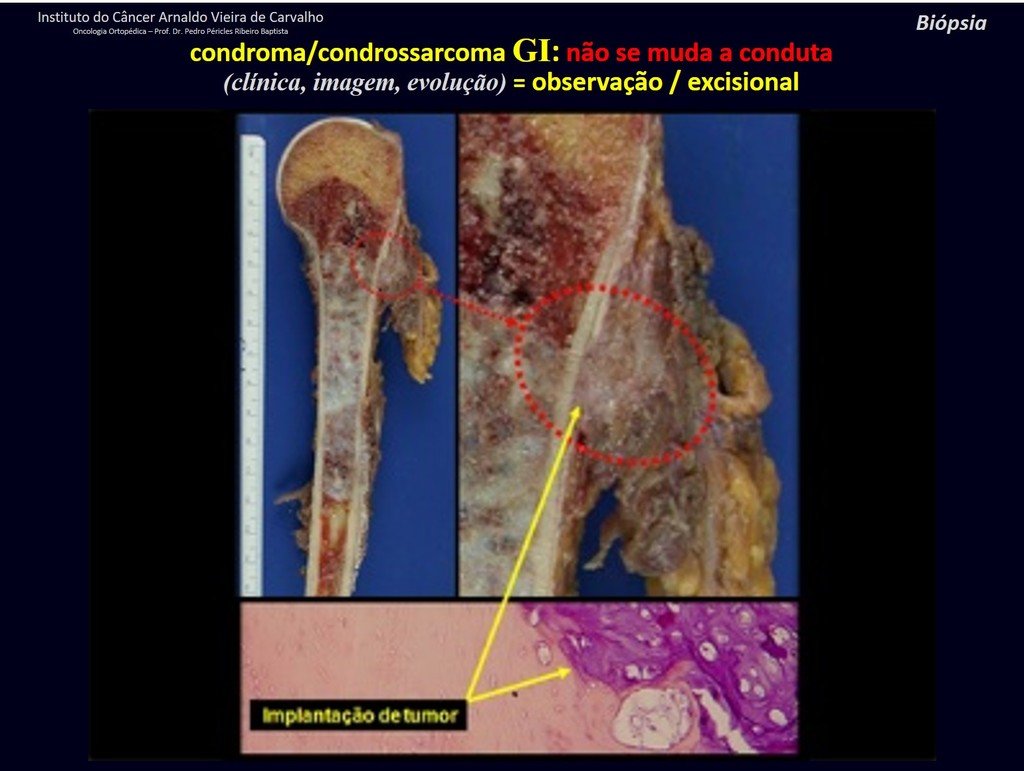 Figura 49: Paciente tratada como condrossarcoma. Peça de paciente operada sem nova biópsia. Podemos verificar em destaque a implantação da neoplasia agressiva nos tecidos moles, através do trajeto da biópsia.