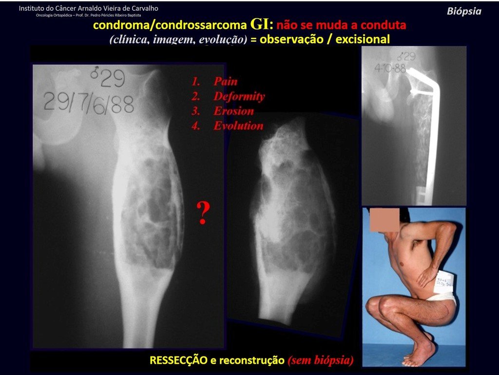 Figura 46: Lesão cartilaginosa do fêmur com todas as características de lesão agressiva. Deve ser tratada como CONDROSSARCOMA.