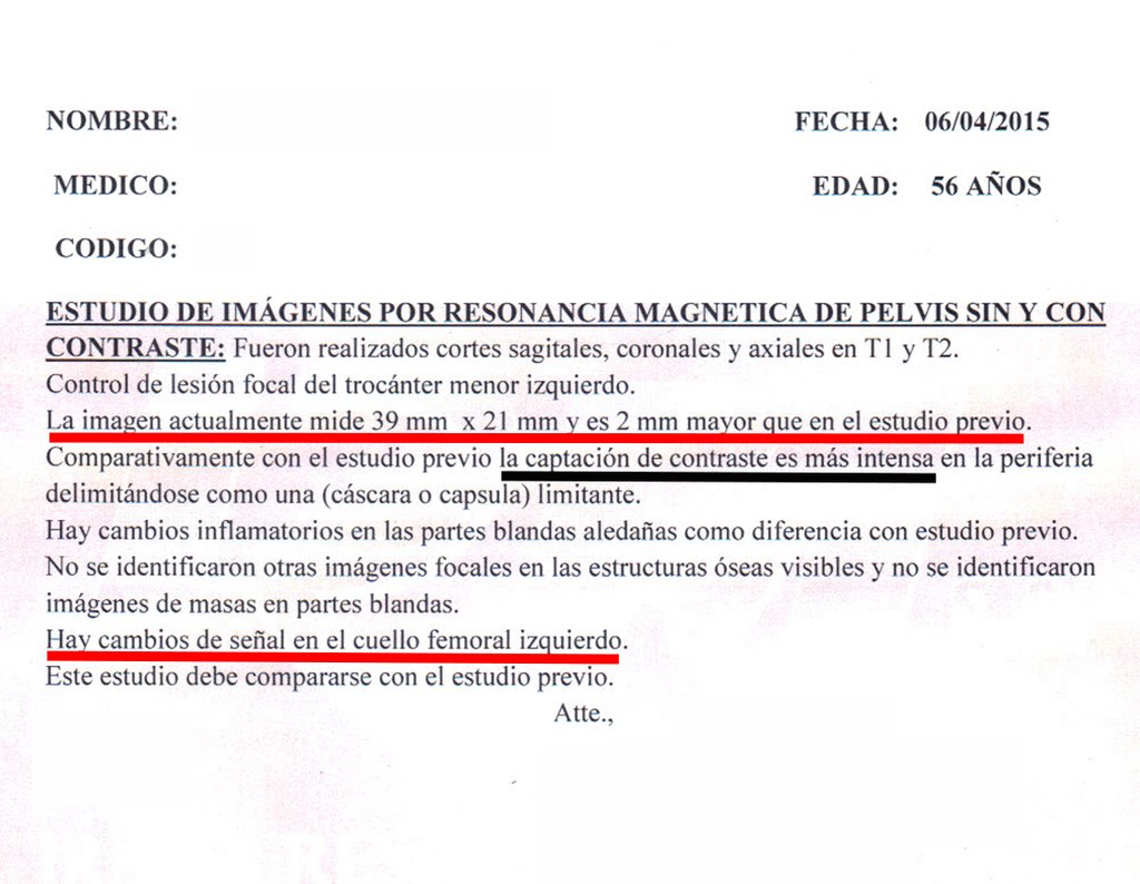 Figura 42: RM axial com lesão lítica no pequeno trocânter. Nesta região do calcar femoral, devido ao ângulo de carga em flexão do quadril, a falta de apoio propicia o stress no colo, levando à fratura.