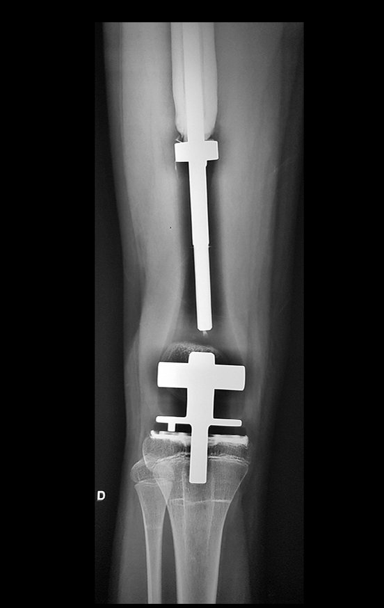 Figura 165: Radiografia de janeiro de 2017. Aumento significativo do crescimento!