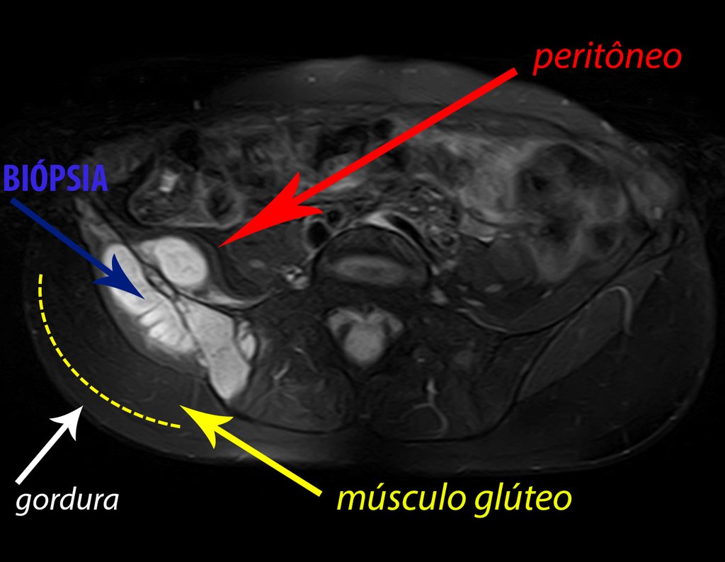 Figura 91: Ressonância axial exibindo os limites do tumor. A lesão extraóssea está delimitada internamente pelo peritônio, seta vermelha, externamente pelo músculo glúteo, seta amarela, recoberta pelo plano gorduroso, seta branca. O trajeto ideal para a biópsia deve ser pela crista ilíaca, seta azul.