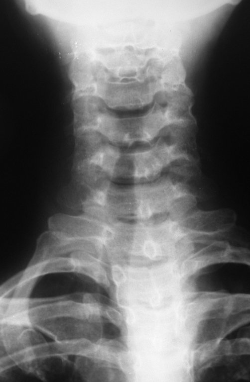 Figura 1: Radiografia (RX) da coluna cervical, sem alterações.