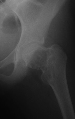 Figura 6: Radiografia da bacia em posição de Lowenstein, documenta a fratura do quadril esquerdo.