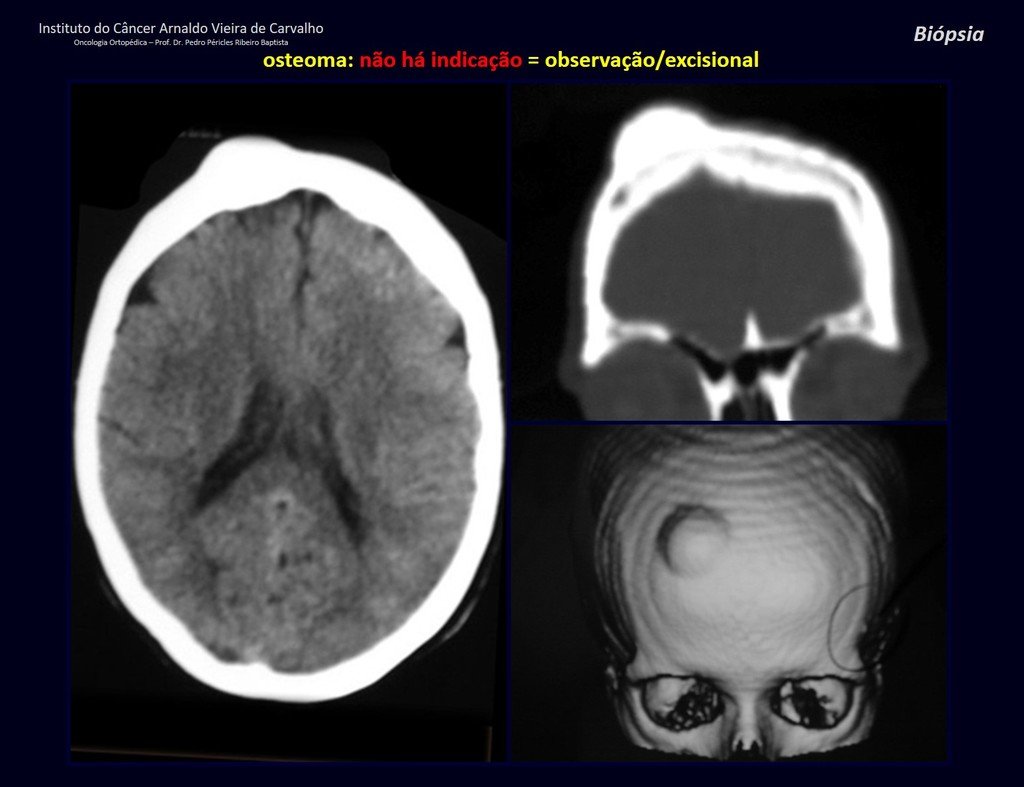 Figura 14: Tomografia exibindo osteoma no crâneo.