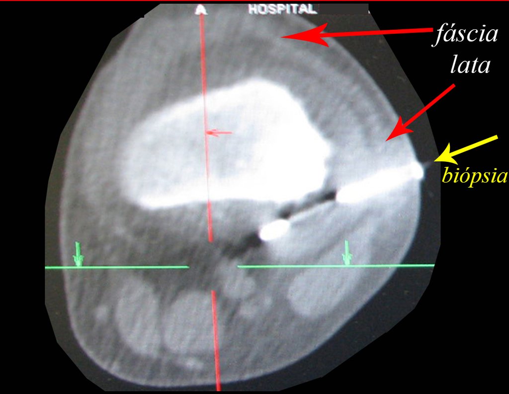 Figura 121: Biópsia realizada abaixo da fáscia lata. Setas em vermelho, controle tomográfico do procedimento, seta amarela.