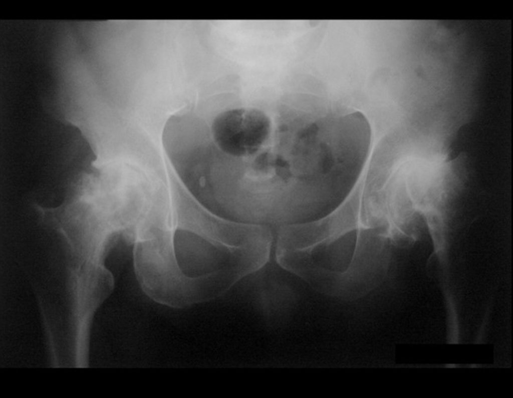 Figura 1: Radiografia da bacia frente, com artrose bilateral dos quadris.