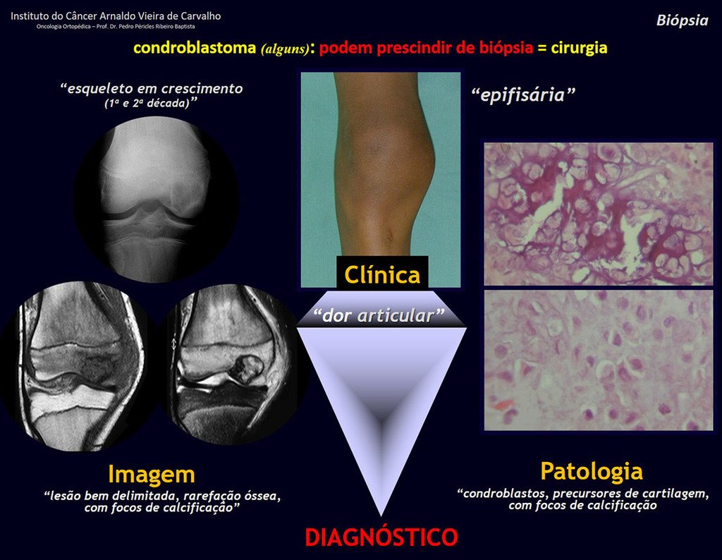 Figura 51: Condroblastoma, tumor epifisário ou apofisário dos ossos longos DO ESQUELETO EM CRESCIMENTO.