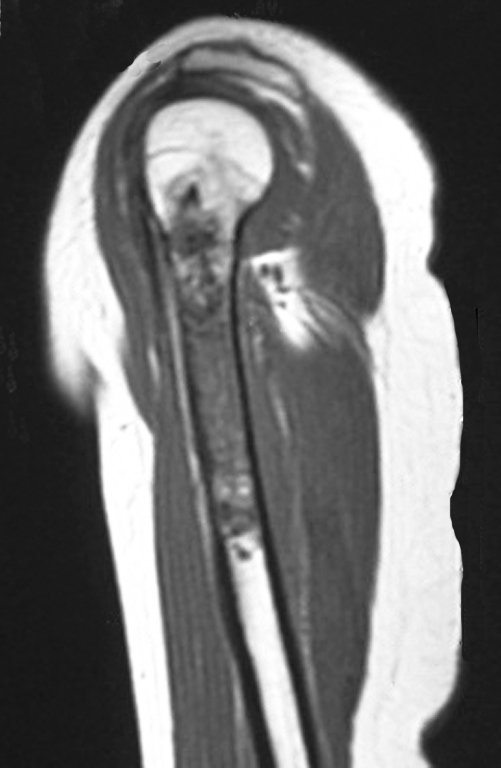 Figura 4.A: Ressonância coronal T1, evidenciando lesão meta-diafisária, sólida, heterogênea, com baixo sinal e sinal intermediário em T1, substituindo a gordura da medular óssea.