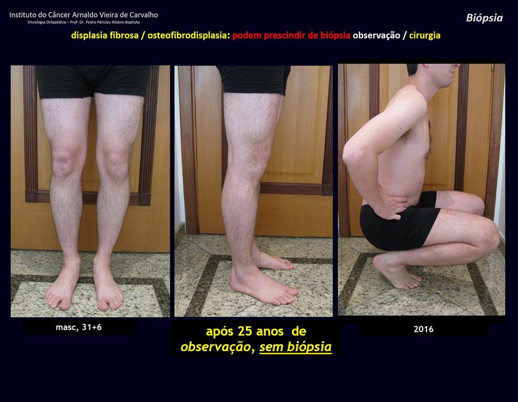 Figura 70: Aspecto clínico e funcional do paciente, após vinte e cinco anos de observação, sem biópsia. Não se deve tratar um rótulo.