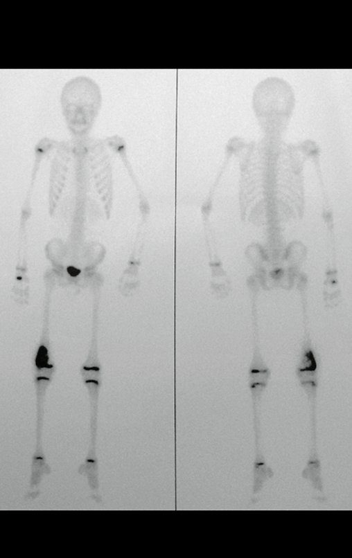 Figura 3: Cintilografia óssea, fase tardia, vista anterior e posterior, com intensa captação na região metafisária distal do fêmur direito.