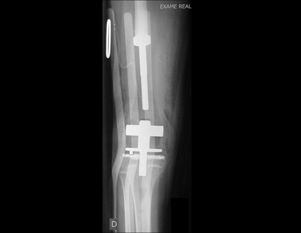 Figura 99: Radiografia frente no pós-operatório imediato, bom posicionamento dos componentes.