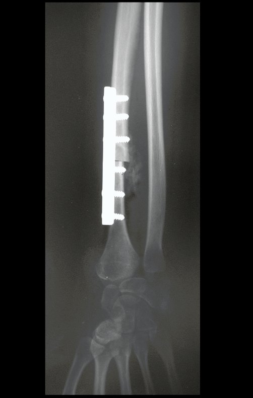 Figura 97: Radiografia frente, após três semanas sem gesso, enxerto com maior rarefação, indicando que o processo de reabsorção e neoformação óssea encontra-se em andamento.