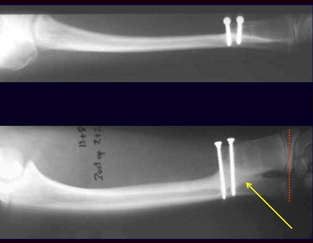 Figura 3: Radiografia após três anos da sinostose radio ulnar distal. Consolidação e total integração do enxerto. As fases do rádio e da ulna continuam com crescimento simétrico.