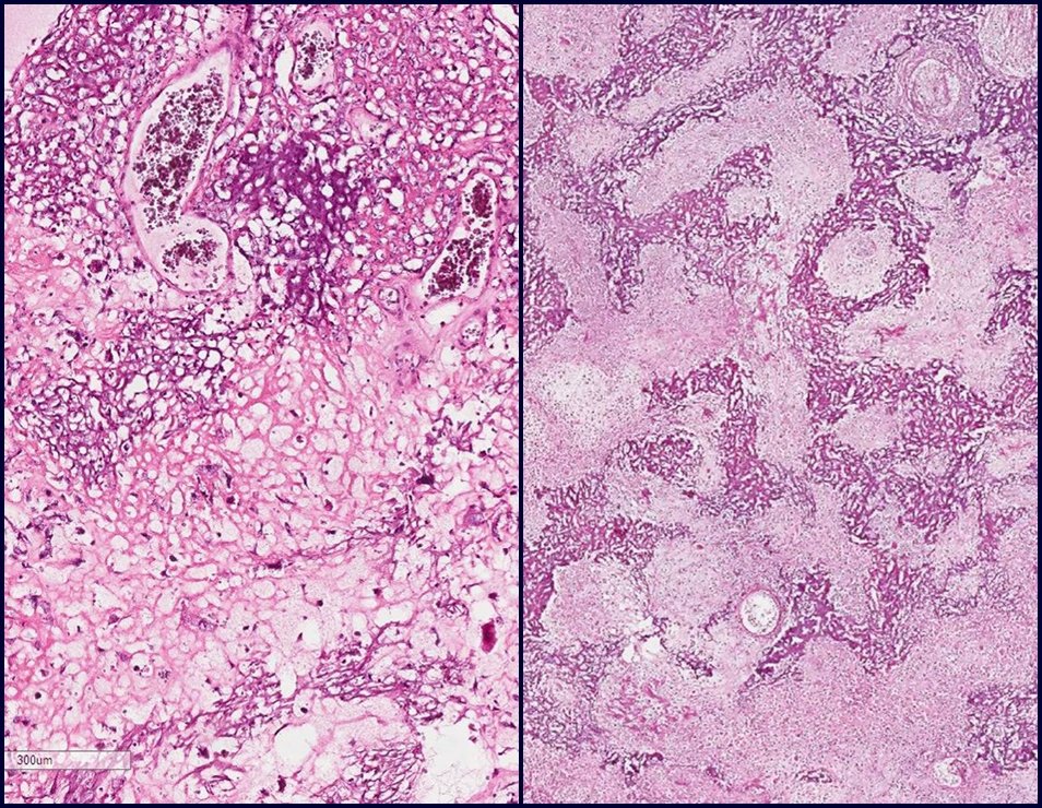 Figura 103: Efeito fibrovascular. Células neoplásicas viáveis.