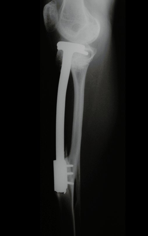 Figura 128: Radiografia perfil, de 31/12/2002, após três anos e dois meses.