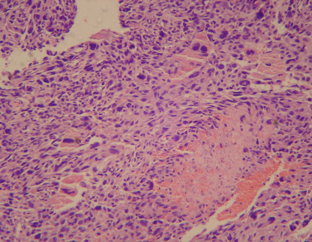 Figura 22: Histologia da biópsia, neoplasia imatura com intenso polimorfismo, hipercromasia, mitoses atípicas e áreas de neoformação óssea, circundadas por células que se assemelham a osteoblastos.